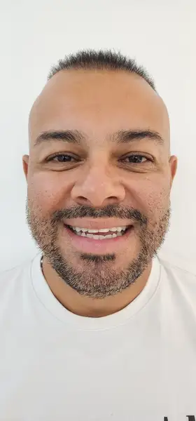 Antes - Carillas de cerámica