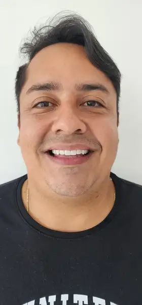 Después - Carillas de resina