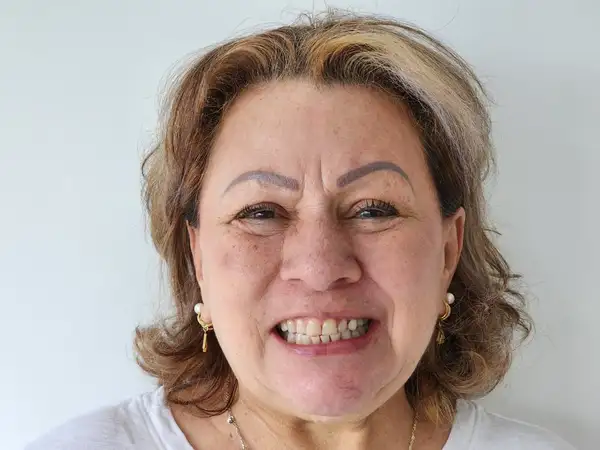 Antes - Rehabilitación oral y diseño de sonrisa